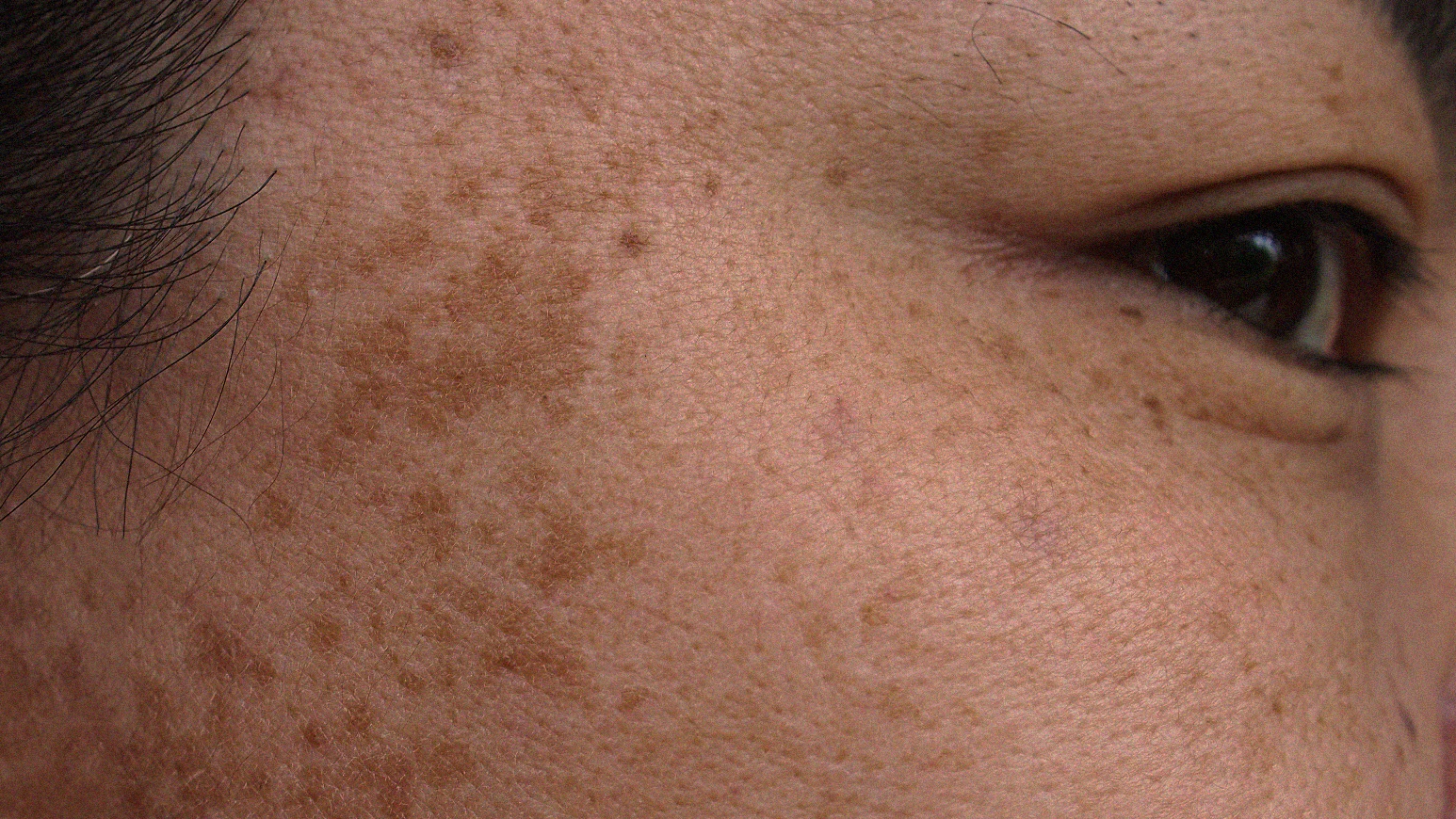Hyperpigmentation